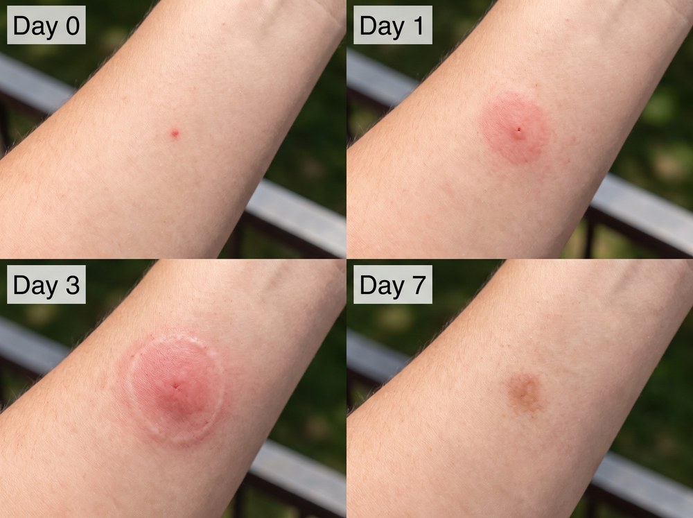 Four panel progression photo showing a wolf spider bite healing from day zero through day seven with fading redness and swelling